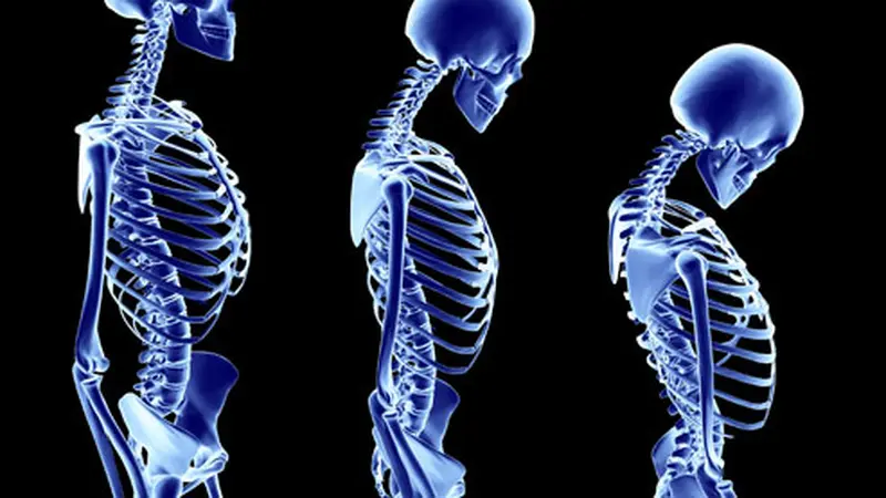 Mencegah Osteoporosis Dan Nyeri Sendi