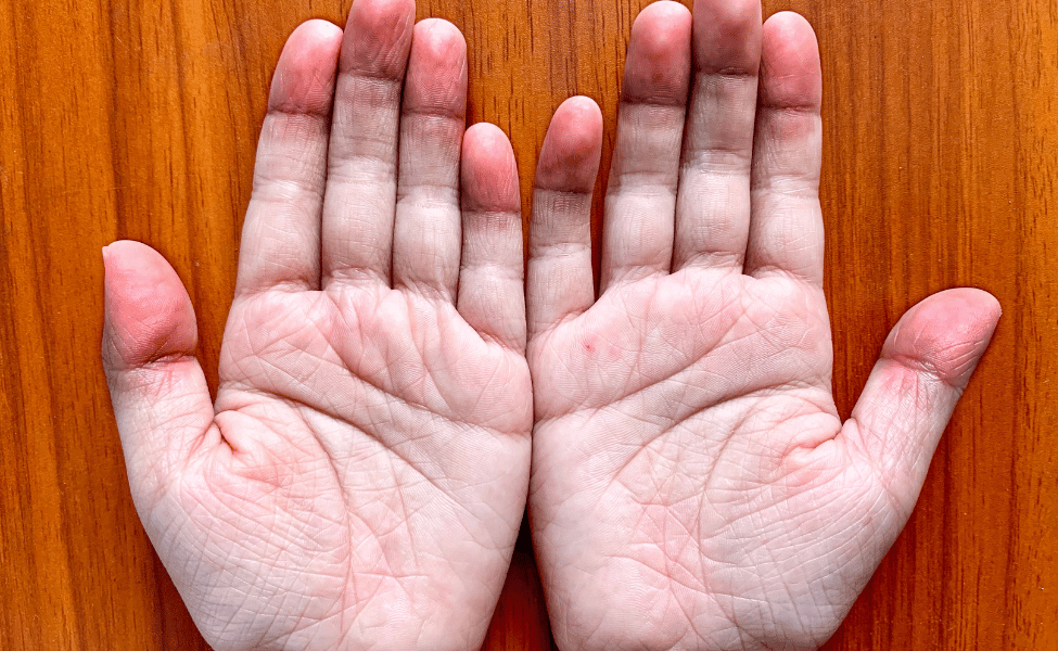 Tanda Epilepsi Yang Wajib Di Pahami Pada Si Kecil