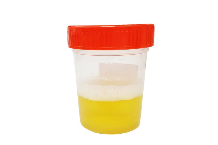 Gagal Ginjal Memiliki Gejala Awal Kencing Berbusa