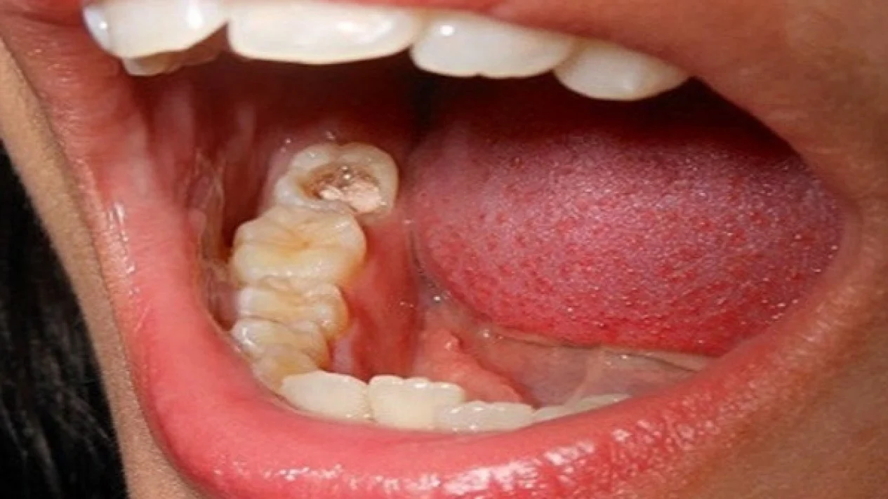 Perawatan Terbaik Untuk Gigi Berlubang Saat Ini