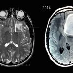 Astrositoma Tumor Otak yang Berasal dari Sel Astrosit