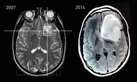 Astrositoma Tumor Otak yang Berasal dari Sel Astrosit