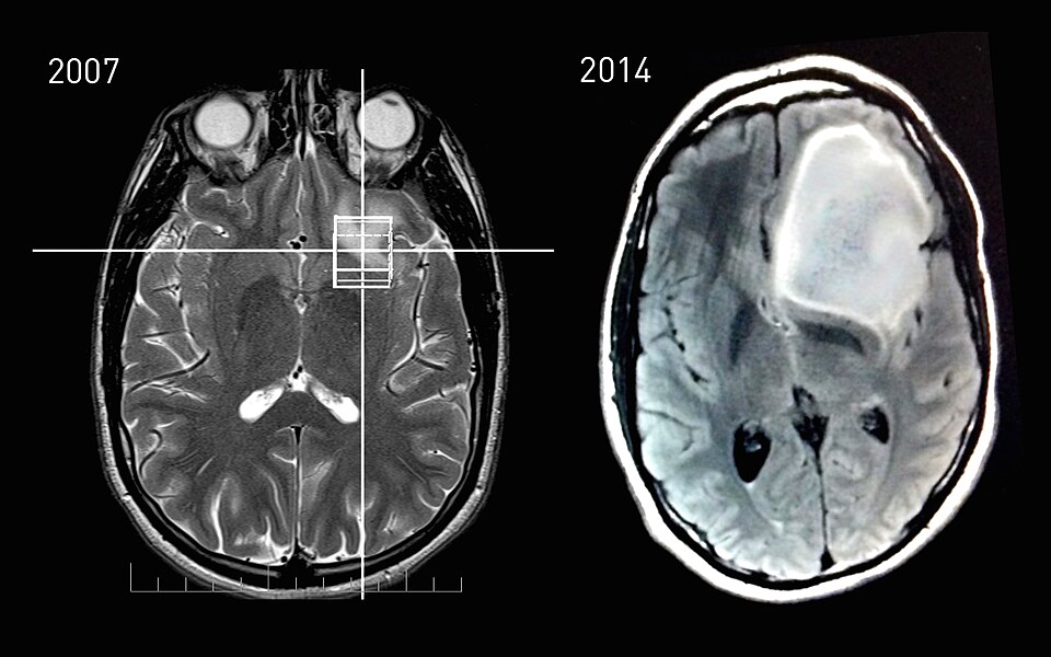 Astrositoma Tumor Otak yang Berasal dari Sel Astrosit