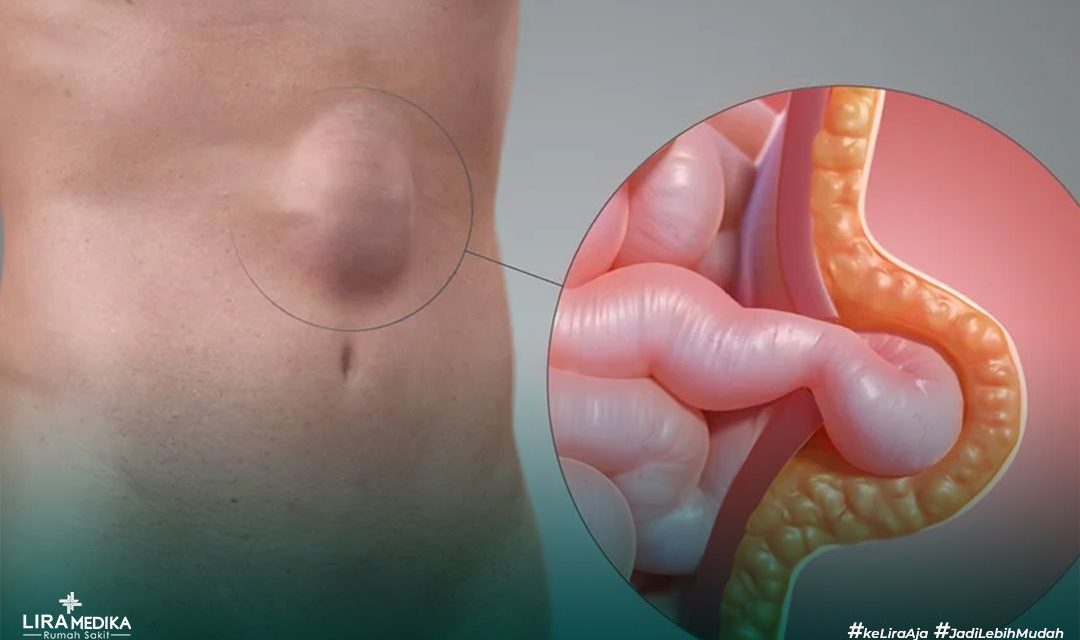 Penyakit Hernia Kenali Gejala, Penyebab Dan Pengobatannya