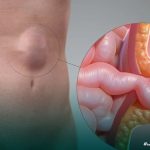 Penyakit Hernia Kenali Gejala, Penyebab Dan Pengobatannya