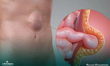 Penyakit Hernia Kenali Gejala, Penyebab Dan Pengobatannya