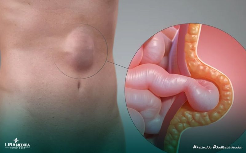 Penyakit Hernia
