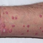 Penyakit Lichen Planus Kenali Gejala Yang Bervariasi