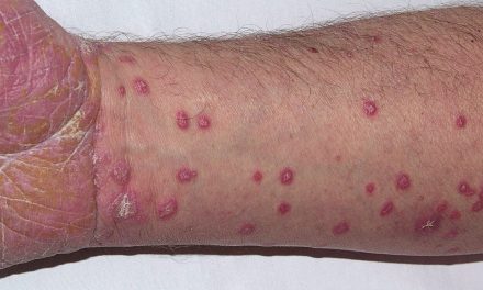 Penyakit Lichen Planus Kenali Gejala Yang Bervariasi