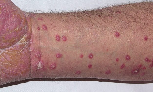 Penyakit Lichen Planus Kenali Gejala Yang Bervariasi