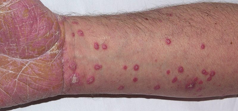 Penyakit Lichen Planus