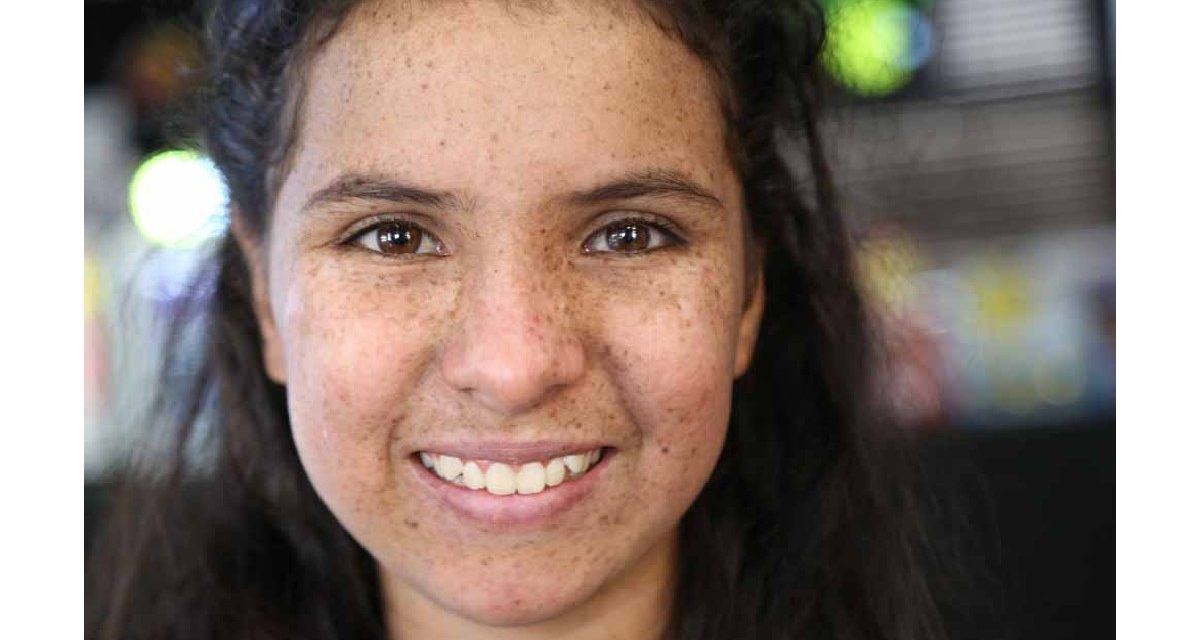 Xeroderma Pigmentosum, Gangguan Genetik Sensitif Matahari