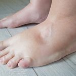 Penyakit Edema Di Tandai Penumpukan Cairan Di Jaringan Tubuh