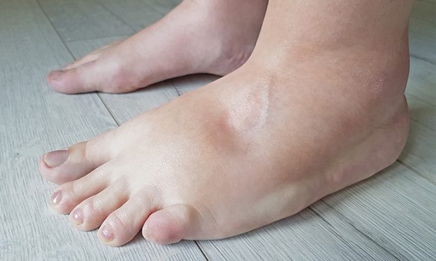 Penyakit Edema Di Tandai Penumpukan Cairan Di Jaringan Tubuh