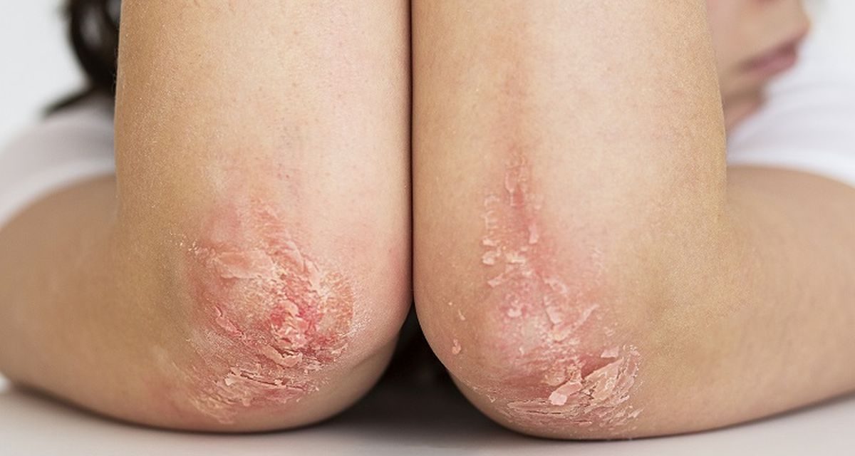 Bahaya Herpes Zoster Dan Pentingnya Vaksinasi