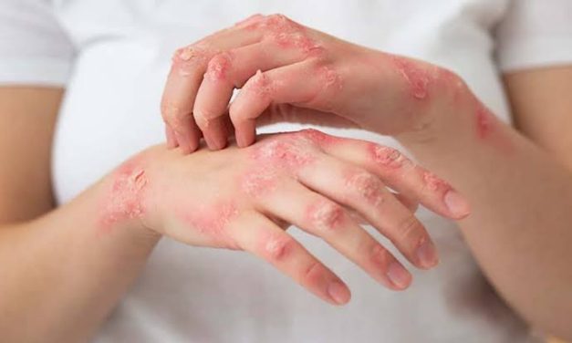 Penyakit Frambusia Di Sebabkan Bakteri Treponema Pertenue