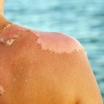 Daftar Produk Salep Panu Yang Dengan Optimal Menyembuhkan