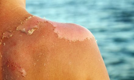 Daftar Produk Salep Panu Yang Dengan Optimal Menyembuhkan